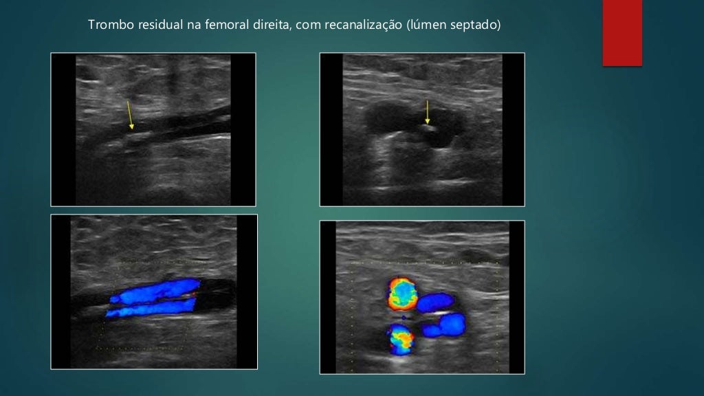 Doppler venoso membros inferiores