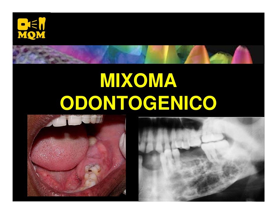MIXOMA ODONTOGENICO
