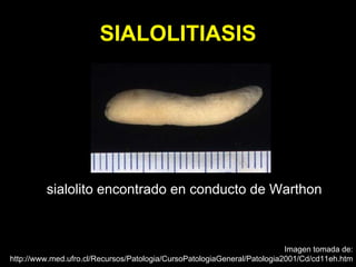 SIALOLITIASIS