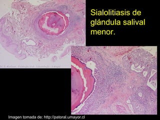 SIALOLITIASIS