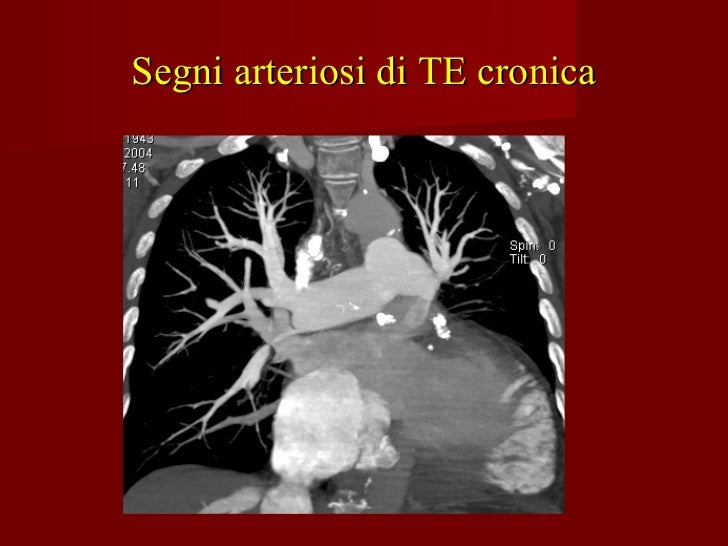 Varicosity a rimedi di gente di gravidanza