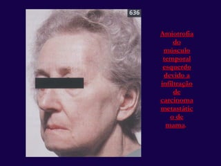 Amiotrofia do músculo temporal esquerdo devido a infiltração de carcinoma metastático de mama .  