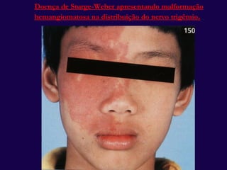 Doença de Sturge-Weber apresentando malformação hemangiomatosa na distribuição do nervo trigêmio . 