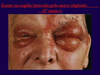 Zoster na região inervada pelo nervo trigêmio  (1 º ramo ). 