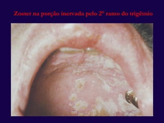 Zoster na porção inervada pelo 2 ° ramo do trigêmio 