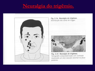 Neuralgia do trigêmio. 