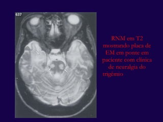 RNM em T2 mostrando placa de EM em ponte em paciente com clínica de neuralgia do trigêmio  