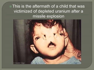 This is the aftermath of a child that was
victimized of depleted uranium after a
missile explosion
 