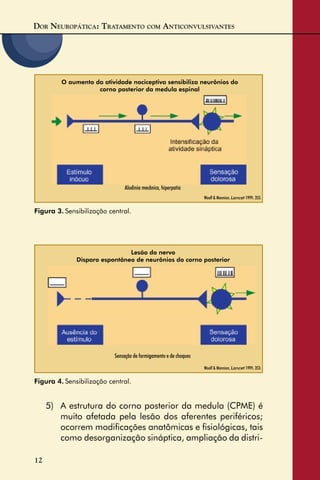 DOR NEUROPÁTICA: TRATAMENTO COM ANTICONVULSIVANTES
12
Figura 4. Sensibilização central.
Woolf & Mannion, Lancet 1999; 353.
Sensação de formigamento e de choques
5) A estrutura do corno posterior da medula (CPME) é
muito afetada pela lesão dos aferentes periféricos;
ocorrem modiﬁcações anatômicas e ﬁsiológicas, tais
como desorganização sináptica, ampliação da distri-
Figura 3. Sensibilização central.
O aumento da atividade nociceptiva sensibiliza neurônios do
corno posterior da medula espinal
Woolf & Mannion, Lancet 1999; 353.
Alodinia mecânica, hiperpatia
Lesão do nervo
Disparo espontâneo de neurônios do corno posterior
 