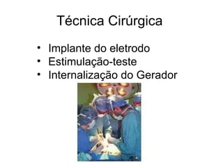 Técnica Cirúrgica  Implante do eletrodo Estimulação-teste  Internalização do Gerador   