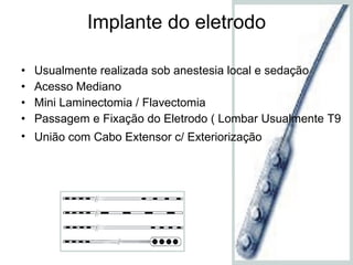 Implante do eletrodo Usualmente realizada sob anestesia local e sedação Acesso Mediano  Mini Laminectomia / Flavectomia Passagem e Fixação do Eletrodo ( Lombar Usualmente T9 União com Cabo Extensor c/ Exteriorização   