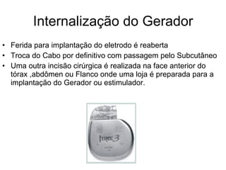 Internalização do Gerador Ferida para implantação do eletrodo é reaberta Troca do Cabo por definitivo com passagem pelo Subcutâneo  Uma outra incisão cirúrgica é realizada na face anterior do tórax ,abdômen ou Flanco onde uma loja é preparada para a implantação do Gerador ou estimulador. 