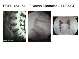 DDD L45+L51 – Fixacao Dinamica ( 11/05/04) 