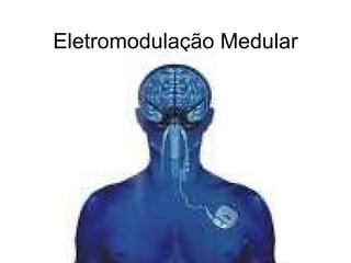 Eletromodulação Medular 