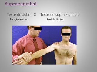 Supraespinhal
Teste de Jobe X Teste do supraespinhal
Posição NeutraRotação Interna
 