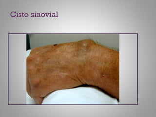 Cisto sinovial
 