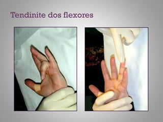 Tendinite dos flexores
 