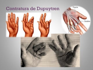 Contratura de Dupuytren
 