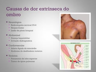 Causas de dor extrínseca do
ombro
 Neurológica
 Radiculopatia cervical C5-6
 Herpes Zoster
 Lesão de plexo braquial
 Abdominal
 Doença hepatobiliar
 Irritação diafragmática
 Cardiovascular
 Infarto Agudo do miocárdio
 Síndrome do desfiladeiro torácico
 Torácica
 Pneumonia de lobo superior
 Tumor de ápice pulmonar
 