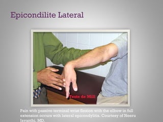 Pain with passive terminal wrist flexion with the elbow in full
extension occurs with lateral epicondylitis. Courtesy of Neeru
Jayanthi, MD.
Teste de Mill
Epicondilite Lateral
 