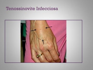 Tenossinovite Infecciosa
 