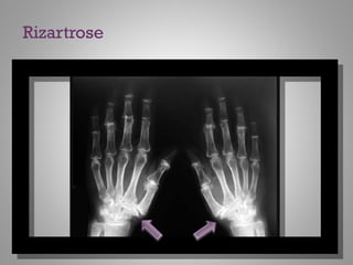 Rizartrose
 