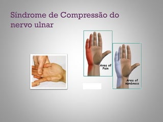 Síndrome de Compressão do
nervo ulnar
 