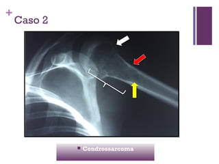 +
Caso 2
 Condrossarcoma
 