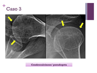 +
Caso 3
Condrocalcinose/ pseudogota
 
