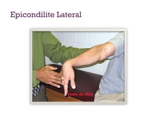 Pain with passive terminal wrist flexion with the elbow in full
extension occurs with lateral epicondylitis. Courtesy of Neeru
Jayanthi, MD.
Teste de Mill
Epicondilite Lateral
 