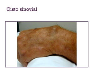 Cisto sinovial
 