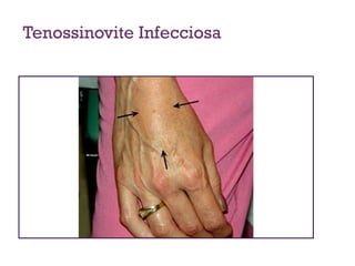 Tenossinovite Infecciosa
 