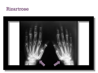 Rizartrose
 