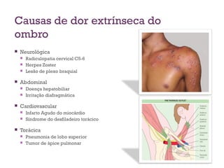 Causas de dor extrínseca do
ombro
 Neurológica
 Radiculopatia cervical C5-6
 Herpes Zoster
 Lesão de plexo braquial
 Abdominal
 Doença hepatobiliar
 Irritação diafragmática
 Cardiovascular
 Infarto Agudo do miocárdio
 Síndrome do desfiladeiro torácico
 Torácica
 Pneumonia de lobo superior
 Tumor de ápice pulmonar
 