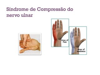 Síndrome de Compressão do
nervo ulnar
 