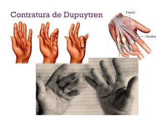 Contratura de Dupuytren
 