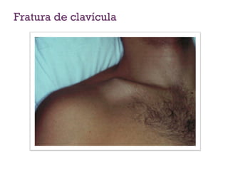 Fratura de clavícula
 
