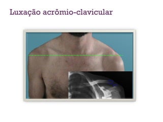 Luxação acrômio-clavicular
 