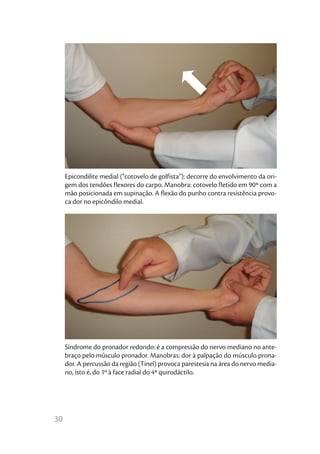 30
Epicondilite medial (“cotovelo de golfista”): decorre do envolvimento da ori-
gem dos tendões flexores do carpo. Manobra: cotovelo fletido em 90º com a
mão posicionada em supinação. A flexão do punho contra resistência provo-
ca dor no epicôndilo medial.
Síndrome do pronador redondo: é a compressão do nervo mediano no ante-
braço pelo músculo pronador. Manobras: dor à palpação do músculo prona-
dor. A percussão da região (Tinel) provoca parestesia na área do nervo media-
no, isto é, do 1º à face radial do 4º quirodáctilo.
 
