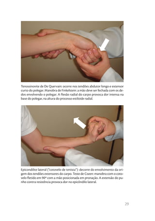 Tenossinovite de De Quervain: ocorre nos tendões abdutor longo e extensor
curto do polegar. Manobra de Finkelstein: a mão deve ser fechada com os de-
dos envolvendo o polegar. A flexão radial do carpo provoca dor intensa na
base do polegar, na altura do processo estiloide radial.




Epicondilite lateral (“cotovelo de tenista”): decorre do envolvimento da ori-
gem dos tendões extensores do carpo. Teste de Cozen: manobra com o coto-
velo fletido em 90º com a mão posicionada em pronação. A extensão do pu-
nho contra resistência provoca dor no epicôndilo lateral.




                                                                                29
 