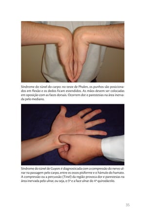 Síndrome do túnel do carpo: no teste de Phalen, os punhos são posiciona-
dos em flexão e os dedos ficam estendidos. As mãos devem ser colocadas
em oposição com as faces dorsais. Ocorrem dor e parestesias na área inerva-
da pelo mediano.




Síndrome do túnel de Guyon: é diagnosticada com a compressão do nervo ul-
nar na passagem pelo carpo, entre os ossos pisiforme e o hámulo do hamato.
A compressão ou a percussão (Tinel) da região provoca dor e parestesias na
área inervada pelo ulnar, ou seja, o 5º e a face ulnar do 4º quirodáctilo.




                                                                              35
 