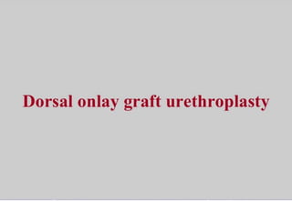 Dorsal oral mucosal onlay graft urethroplasty