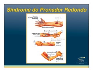 Síndrome do Pronador RedondoSíndrome do Pronador Redondo
 