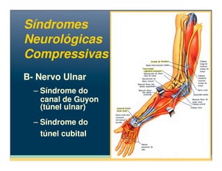 B- Nervo UlnarB- Nervo Ulnar
Síndromes
Neurológicas
Compressivas
Síndromes
Neurológicas
Compressivas
– Síndrome do
canal de Guyon
(túnel ulnar)
– Síndrome do
túnel cubital
– Síndrome do
canal de Guyon
(túnel ulnar)
– Síndrome do
túnel cubital
 