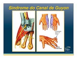 Síndrome do Canal de GuyonSíndrome do Canal de Guyon
 