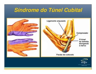 Síndrome do Túnel CubitalSíndrome do Túnel Cubital
 