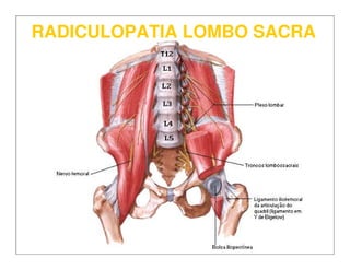 RADICULOPATIA LOMBO SACRARADICULOPATIA LOMBO SACRA
 