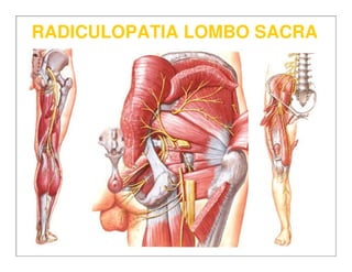 RADICULOPATIA LOMBO SACRARADICULOPATIA LOMBO SACRA
 