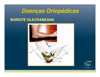 BURSITE OLECRANEANABURSITE OLECRANEANA
Doenças OrtopédicasDoenças Ortopédicas
 