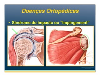 • Síndrome do impacto ou “Impingement”• Síndrome do impacto ou “Impingement”
Doenças OrtopédicasDoenças Ortopédicas
 